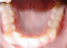 Invisalign Treatment