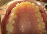 Invisalign Treatment