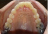 Invisalign Treatment