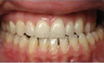 Invisalign Treatment