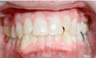 Invisalign Treatment
