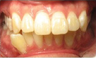 Invisalign Treatment