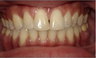 Invisalign Treatment