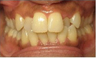 Invisalign Treatment