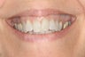 Invisalign and Whitening