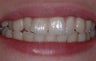 INVISALIGN