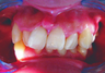 Complex orthodontics with Invisalign