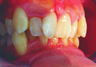 Complex orthodontics with Invisalign
