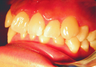 Complex orthodontics with Invisalign