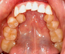 Invisalign