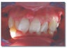 Invisalign for severe crowding/ non extraction