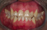 Invisalign