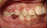 Invisalign Treatment