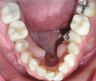 Invisalign used to upright the teeth and broaden the smile.