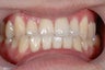 Invisalign Treatment