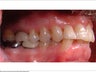 Invisalign
