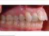 Invisalign