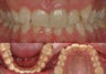 Invisalign braces, whitening and minor gum lift.