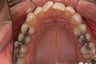 Invisalign