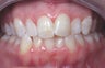 Invisalign
