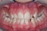 Invisalign