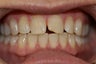 Upper anterior crowns to close gaps & Invisalign
