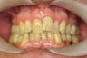 Invisalign
