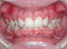 Deep Overbite Correction