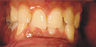 Invisalign for complex cases
