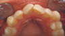 Invisalign 9 years ago
