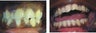 Invisalign for extreme crowding