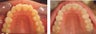 Twisted incisors treated with Invisalign