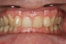 Invisalign Treatment