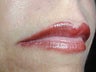 Juvederm to upper lip