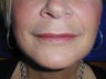 Juvederm to upper lip