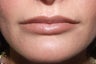 Lip augmentation