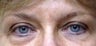 Botox and Juvederm to glabellar lines