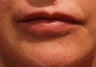 Lip Augmentation