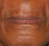 Lip augmentation with juvederm