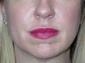 Fillers