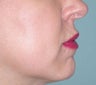 Fillers