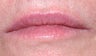 Juvederm and Botox to lips