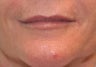 Juvederm filler to the lips