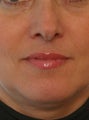 Juvederm