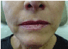 juvederm