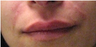 Juvederm