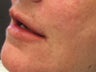 Juvederm Ultra