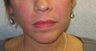 Juvederm for lines around the mouth