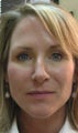 Juvederm Injection to Nasolabial Folds