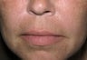 Juvederm